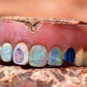 Opal Dentures