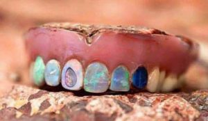 Hodge's Opal Dentures