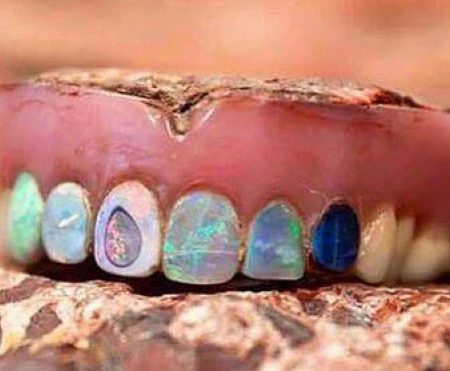 Opal Dentures