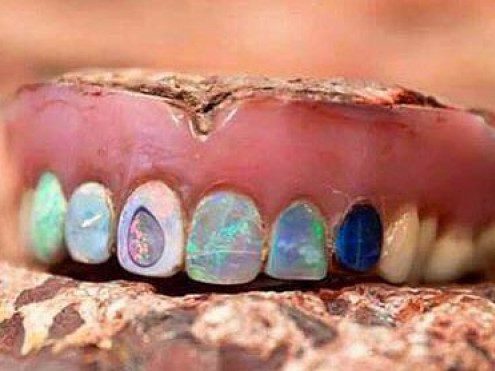Opal Dentures