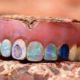 Opal Dentures